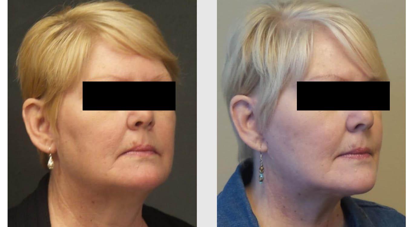 Facelift Before and after result