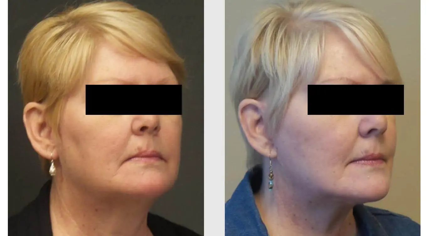 Facelift Before and after result