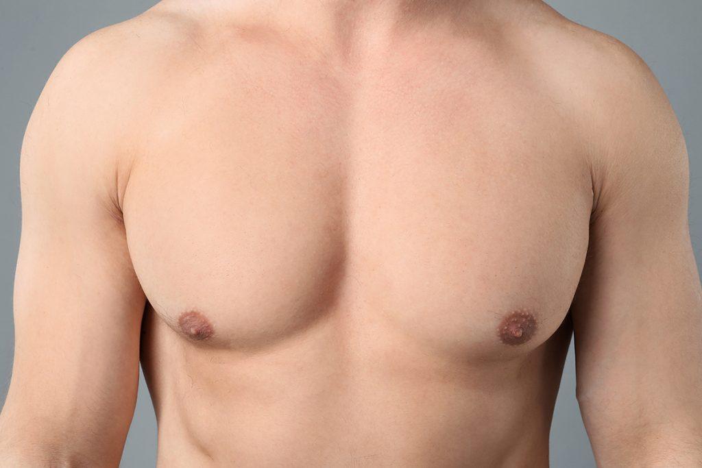 Gynecomastia