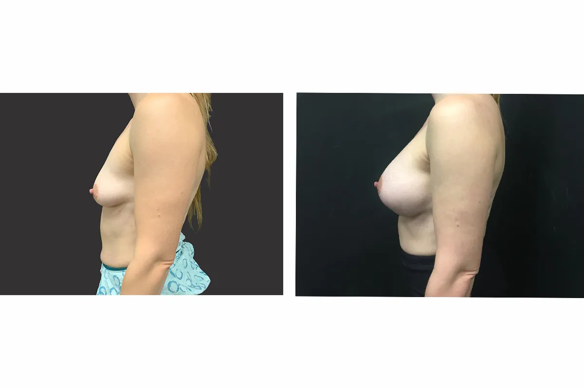 XL Breast Implants Before & After Results
