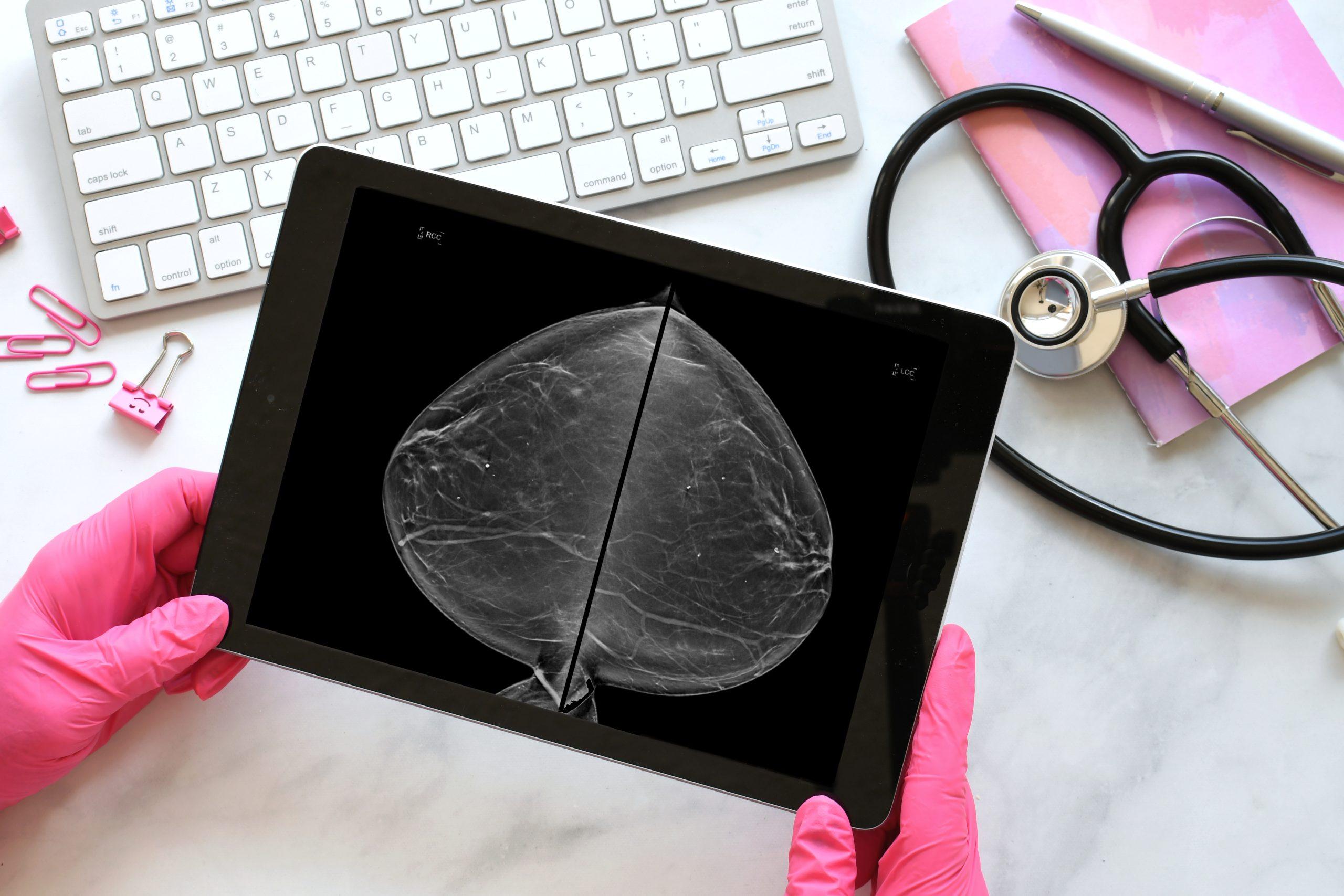 How to Get Rid of Breast Calcifications